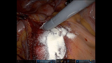 An Image From " Robotic Pelvic Dissection Featuring SURGICEL® Powder Absorbable Hemostat with Jonathan D. Black, MD, MPH"