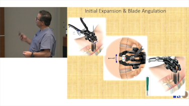 An image from the "Left Lateral Retroperitoneal Approach - Implant Placement with Andrew Sama, MD" video on the JnJInstitue.com website.