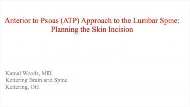 image from "Anterior to Psoas (ATP) Approach to the Lumbar Spine: Planning the Skin Incision with Kamal Woods, MD " video on jnjinstitute.com