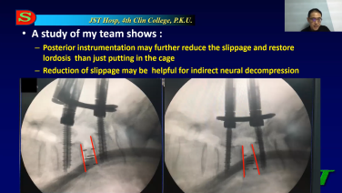 An image from the "Microlearning ATP/OLIF Treatment for Complex Lumbar Spinal Stenosis" video on the JnJInstitute.com website.