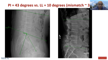 An image from the "Microlearning: ATP (Anterior to Psoas) Technique - Case Presentation" video on the JnJInstitute.com website.