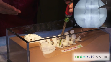 An image from the "UNLEASH MIS TLIF Procedural Solution - Screw Placement Technique with Michael Wang, MD" video on the JnJInstitue.com website.
