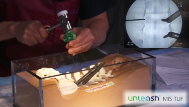 An image from the "UNLEASH MIS TLIF Procedural Solution - Guidewire Placement with Michael Wang, MD" video on the JnJInstitute.com website.