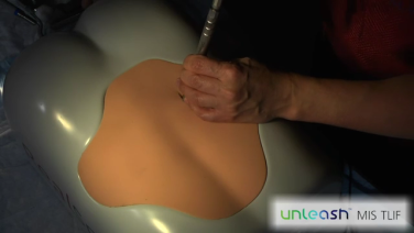 SPOTLIGHT Retractor System: Tubular Retractor Insertion with Michael Wang, MD thumbnail