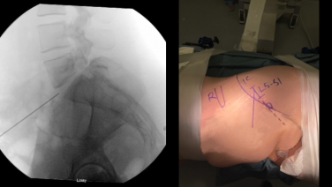 An image from the "Minimally Invasive Spine Surgery: Anterior to Psoas Surgical Technique, L5-S1 Anatomy Under the Microscope" video on the JnJInstitute.com website.