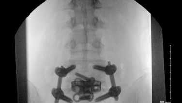 An image from the "Minimally Invasive Spine Surgery: Anterior to Psoas Surgical Technique, L5-S1 Anatomy Under the Microscope" video on the JnJInstitute.com website.