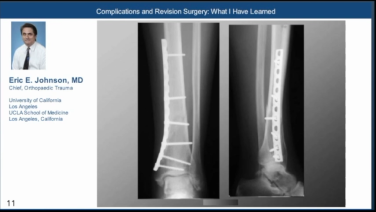 An image from the "Massive Cuff Tear: Strategies & Techniques with Peter Chalmers, MD" video on the JnJInstitue.com website.
