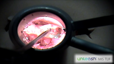 An image from the "UNLEASH MIS TLIF Procedural Solution - Facetectomy with Michael Wang, MD" video on the JnJinstitute.com website.