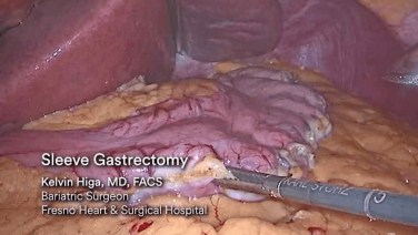 An Image From "Laparoscopic Sleeve Gastrectomy using ECHELON+ with Kelvin Higa, MD"