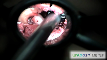 An image from the "UNLEASH MIS TLIF Procedural Solution - Cage Insertion with Michael Wang, MD" video on the JnJInstitute.com website.