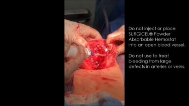 An Image From "Managing Bleeding During an Open Myomectomy featuring SURGICEL® Powder Absorbable Hemostat with Steven D. McCarus, MD, FACOG"
