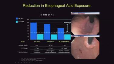 image of "Gastroesophageal Reflux Disease: We Need A Better Mouse Trap" video on jnjinstitute.com