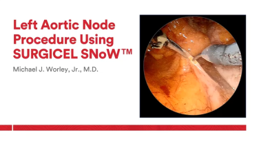 An Image From "Left Aortic Node Procedure using SURGICEL with Dr. Worley, Jr."