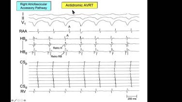 An Image From "Challenging Accessory Pathways, Part III: Mahaim Accessory Pathways with Warren "Sonny" Jackman, MD"