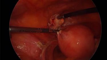 An Image From "Enseal X1 Procedure Video - McCarus Lt. Ovary Video"