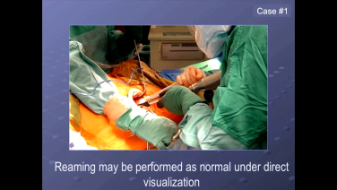 An image from the "Anterior Approach: Acetabular Reaming with Joel Matta, MD" video on the JnJInstitute.com website.