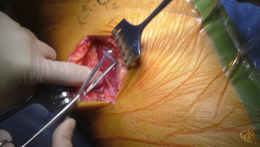 An image from the "Anterior Approach: Incision, Capsular Exposure & Neck Cut with Charles DeCook, MD" video on the JnJInstitute.com website.