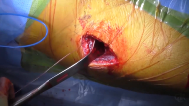 image of Anterior Approach: Acetabulum Exposure, Preparation & Cup Insertion with Charles DeCook, MD video on jnjinstitute.com