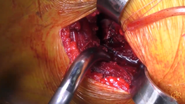 An image from the "Anterior Approach: Femoral Exposure & Preparation with Charles DeCook, MD" video on the JnJInstitute.com website.d