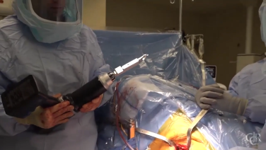 image of Anterior Approach: Femoral Broaching & Stem Insertion with Charles DeCook, MD video on jnjinstitute.com