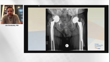 An image from the "Anterior Approach: Revision THA: Case Studies with Nader Nassif, MD, Eric Smith, MD, Joseph Gondusky, MD, & Ryan Nunley, MD" video on the JnJInstitute.com website.