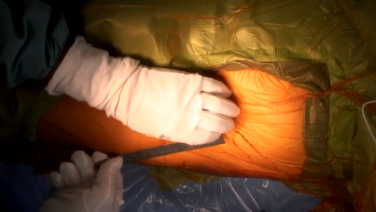 image of Anterior Approach: Incision & Initial Exposure with Joel Matta, MD video on jnjinstitute.com