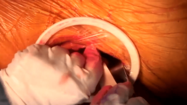 image of Anterior Approach: Capsular Exposure with Joel Matta, MD video on jnjinstitute.com