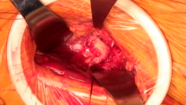 image of Anterior Approach: Dislocation with Joel Matta, MD video on jnjinstitute.com