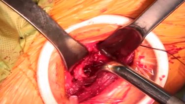 image of Anterior Approach: Femoral Broaching with Joel Matta, MD video on jnjinstitute.com
