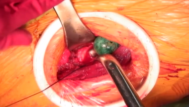 image of Anterior Approach: Femoral Trialing with Joel Matta, MD video jnjinstitute.com