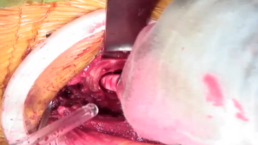 image of Anterior Approach: Final Implantation with Joel Matta, MD video on jnjinstitute.com