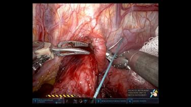 An image From "Large Hiatal Hernia - LINX Sizer"