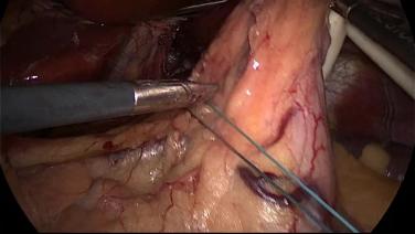 An Image From "Medium Hiatal Hernia - LINX Sizer"