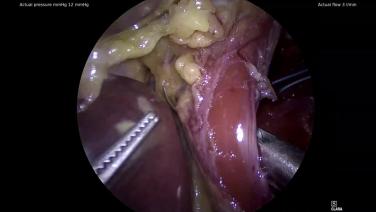 An Image From "No Hiatal Hernia - LINX Sizer"