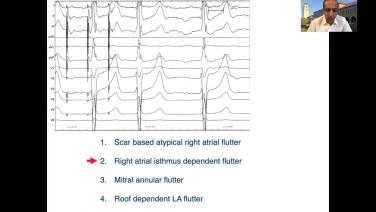 Case Based Approach to Ablation of Atrial Flutter with Nitish Badhwar, MD Header Image