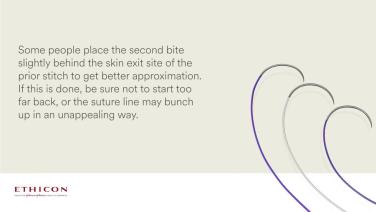 image of "Subcuticular Suture Technique" video on jnjinstitute.com