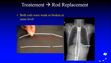 An image from the "Complications of EOS & Management with Burt Yaszay, MD" video on the JnJInstitute.com website.