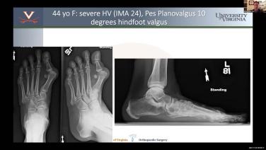 image of Management of Foot & Ankle Deformities Master Class with Joseph Park, MD - Part 5 video on jnjinstitute.com