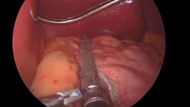 An image from "Sleeve Gastrectomy with the ECHELON 3000 stapler and ECHELON Staple Line Reinforcement"