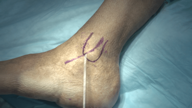 Brostrom Repair with Sarang Desai, MD thumbnail