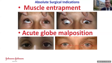An image from the "Concepts in Orbital Reconstruction: Surgical Indications with Edward Davidson, MD" video on the JnJInstitute.com website.