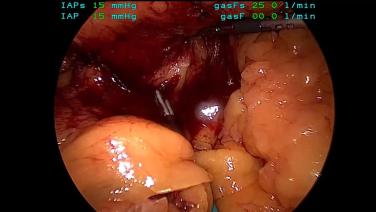 An Image from "Jean Ashburn, MD performing a Right Colectomy using the ECHELON 3000 Stapler and ENSEAL X1 Straight Jaw"