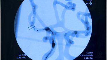 An Image from "CERENOVUS Stroke Solutions™ Review with Jan-Karl Burkhardt, MD"