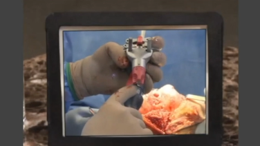 An image from the "ATTUNE Knee System & INTUITION Instruments: Total Knee Arthroplasty Distal Femoral Resection with David Dalury, MD & David Fisher, MD" video on the JnJInstitute.com website.