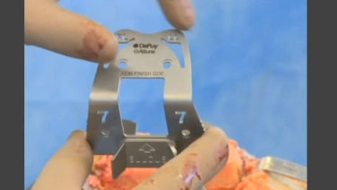 An image from the "ATTUNE™ Knee System & INTUITION™ Instruments Total Knee Arthroplasty: Cruciate Retaining Sulcus & Posterior Condyle Resection with David Dalury, MD & David Fisher, MD" video on the JnJInstitute.com website.