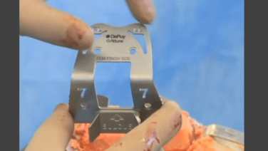 An image from the "ATTUNE™ Knee System & INTUITION™ Instruments Total Knee Arthroplasty: Cruciate Retaining Sulcus & Posterior Condyle Resection with David Dalury, MD & David Fisher, MD" video on the JnJInstitute.com website.