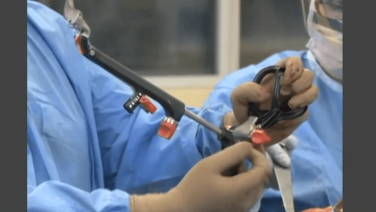 An image from the :"ATTUNE™ Knee System & INTUITION™ Instruments Total Knee Arthroplasty: Tibial Resection with David Dalury, MD & David Fisher, MD" video on the JnJInstitute.com website.