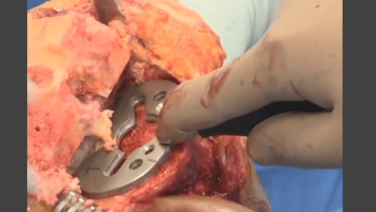 An image from the "ATTUNE™ Knee System & INTUITION™ Instruments Total Knee Arthroplasty: Tibial Sizing with David Dalury, MD & David Fisher, MD" video on the JnJInstitute.com website.