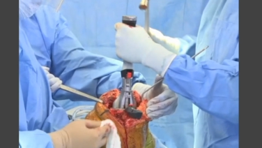 An image from the "ATTUNE™ Knee System & INTUITION™ Instruments Total Knee Arthroplasty: Tibial Preparation with David Dalury, MD & David Fisher, MD" video on the JnJIsnstitute.com website.