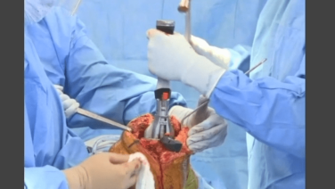 An image from the "ATTUNE™ Knee System & INTUITION™ Instruments Total Knee Arthroplasty: Tibial Preparation with David Dalury, MD & David Fisher, MD" video on the JnJIsnstitute.com website.